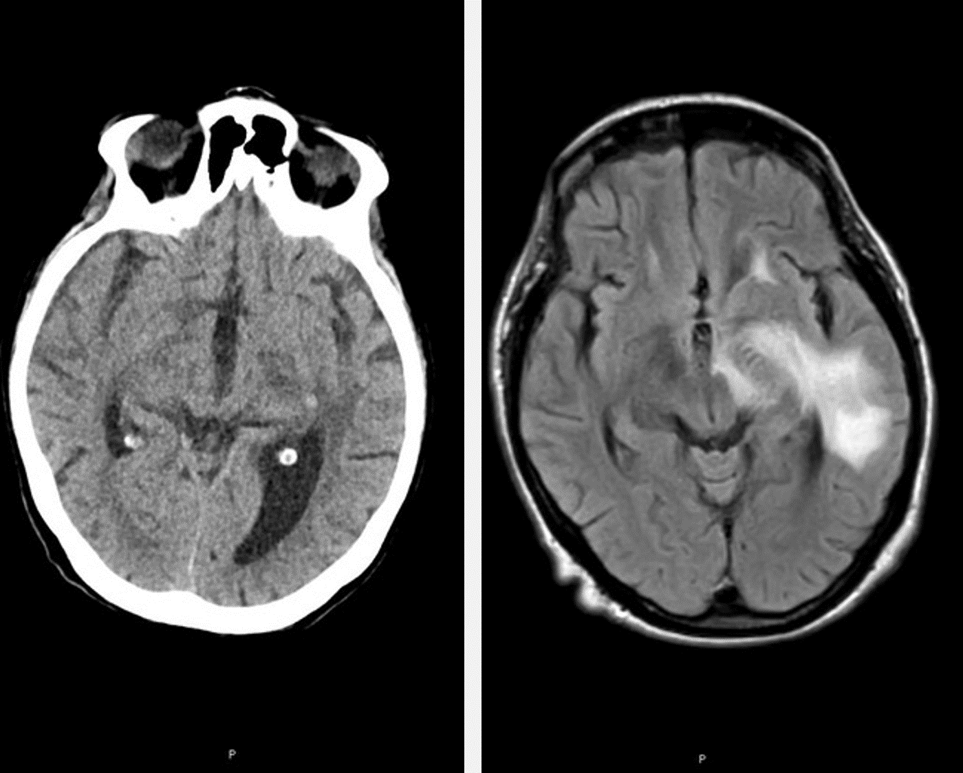 Qynapse supports the investigation of COVID-19 neurological manifestations